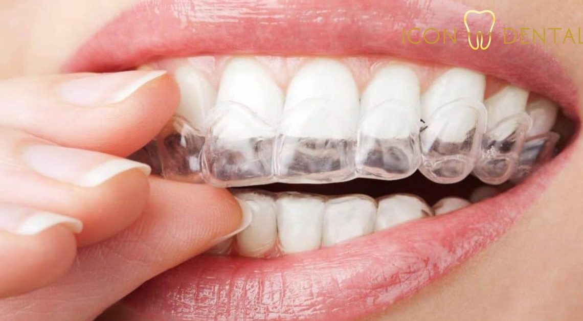 invisalign price malaysia