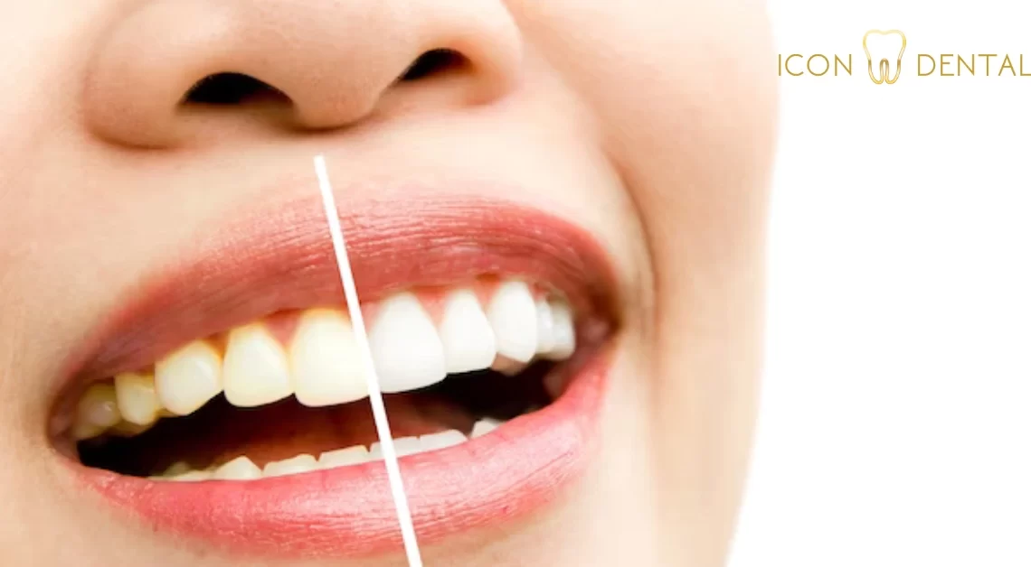 teeth whitening malaysia