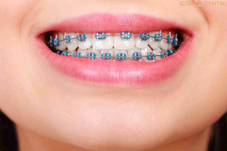 braces price selangor