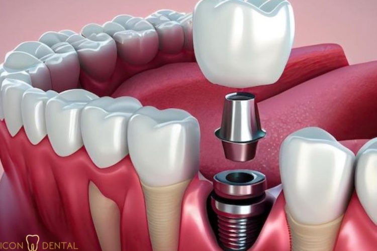 dental implant cost malaysia